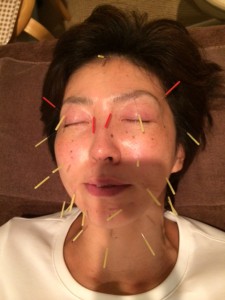 美容鍼140922-3