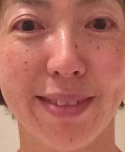 美容鍼140922-5拡大