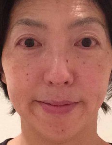 美容鍼140929顔後